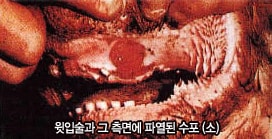 윗입술과 그 측면에 파열된 수포 (소)